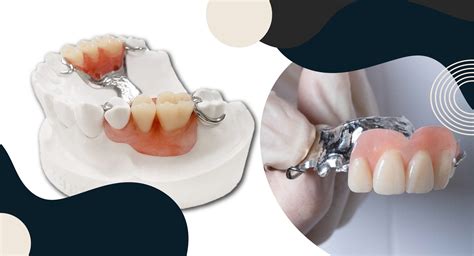 a removable partial denture cast metal framework is fabricated|mandibular partial denture cast metal.